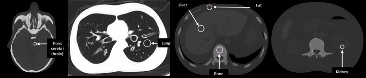 CT radiation dose reduction with tin filter for localisation/characterisation level image quality in PET-CT: a phantom study.