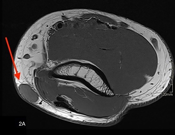 Extradigital Glomus Tumor at the Elbow.