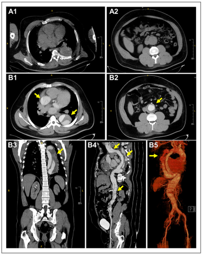 Stanford Type A Aortic Dissection Masquerading as Acute Ischemic Stroke: A Case Report.