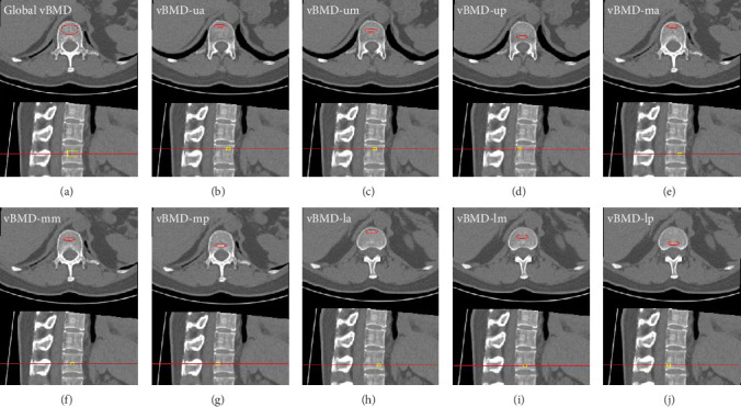 High-Risk Analysis of Vertebral Compression Fractures With Type 2 Diabetes Mellitus: Site-Specific Volumetric Bone Mineral Density.