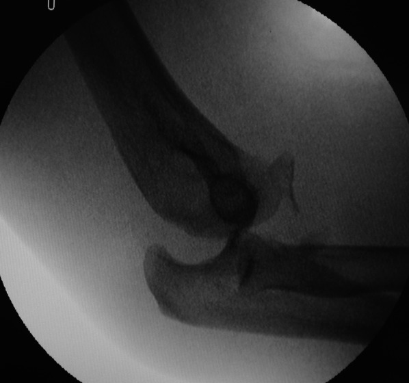 Outcomes of coronoid-first repair through an anterior approach in patients with terrible triad injury of the elbow: a prospective study with a minimum 2-year follow-up.