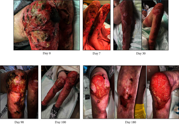 Treatment of Xylazine-Associated Injection Skin Injuries.