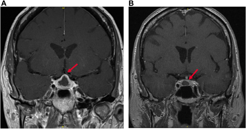 Panhypopituitarism Secondary to Pituitary Abscess