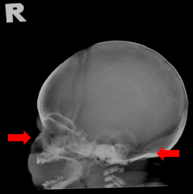 Prenatal diagnosis of achondroplasia in primary care settings - Recognising the soft markers: A case report.