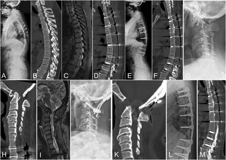 Factors Affecting the Surgical Outcomes of Patients Treated With "de-tension" Surgical Strategy for Multilevel Ossification of the Posterior Longitudinal Ligament in the Thoracic Spine: A Minimum 2-year Follow-Up Study of 83 Patients in a Single Center.