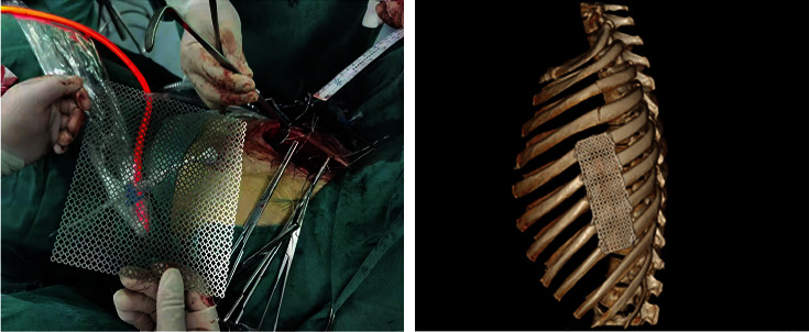 Application of Titanium Mesh in the Early Treatment of Flail Chest.