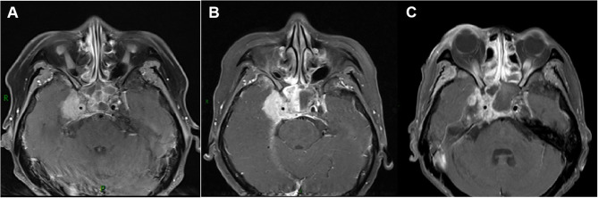 Efficacy and Safety of Neoadjuvant Immunotherapy Combined with Sandwich Chemoradiotherapy in Locally Advanced Nasopharyngeal Carcinoma: A Retrospective Study.