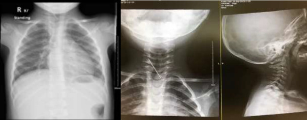 Incidental Radiological Finding of an Intravenous Needle in a Pediatric Cervical Spine.