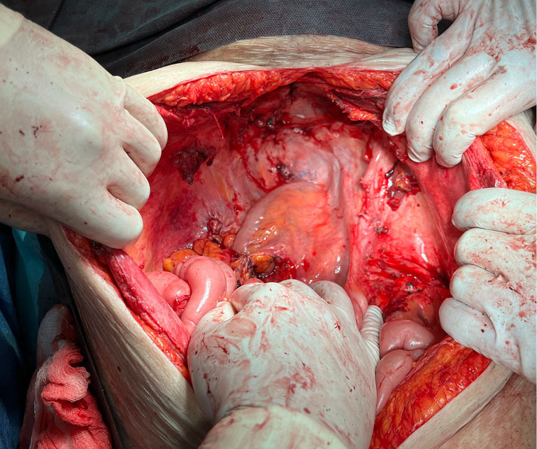 Radical tumor resection of a relapsed high-grade endometrial stromal sarcoma with an extremely rare mutation: a case report.