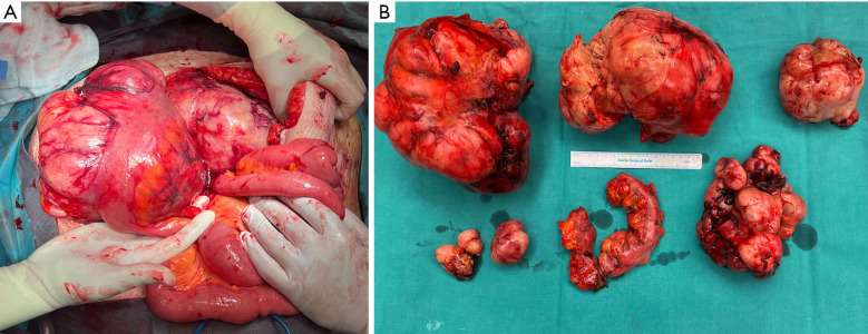 Radical tumor resection of a relapsed high-grade endometrial stromal sarcoma with an extremely rare mutation: a case report.