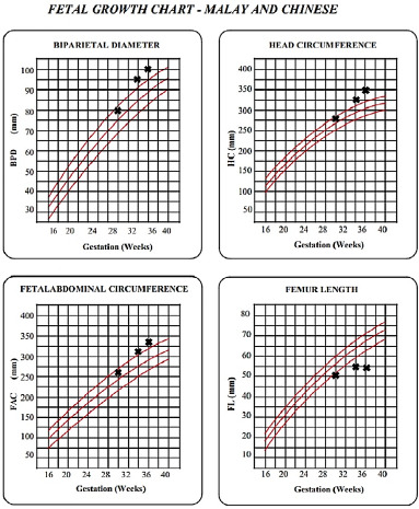Prenatal diagnosis of achondroplasia in primary care settings - Recognising the soft markers: A case report.