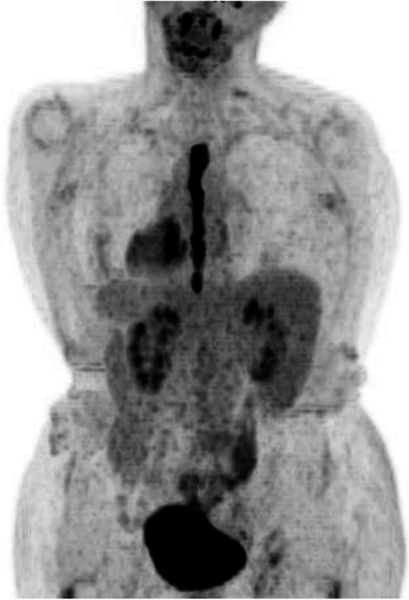 Sternotomy and extracorporal circulation for fulminant Budd-Chiari syndrome due to leiomyosarcoma of the inferior vena cava.