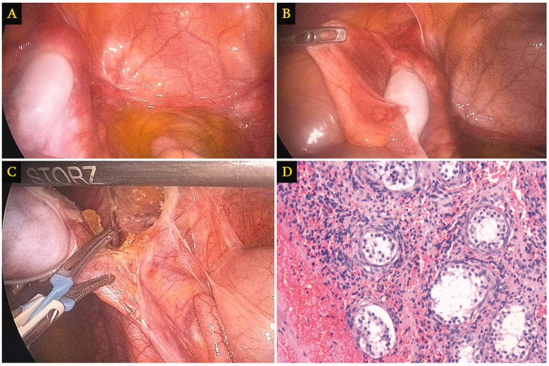 Complexities of complete androgen insensitivity syndrome: insights from a case report and literature review.