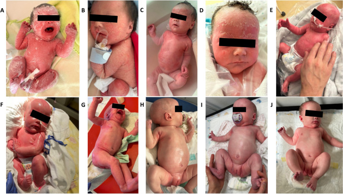 Dupilumab in a 9-week-old with Netherton Syndrome Leads to Deep Symptom Control.