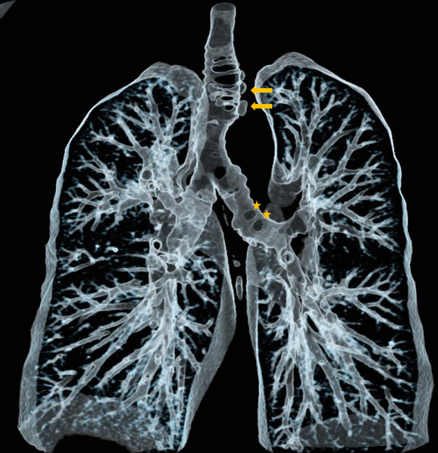 Tracheobronchial Diverticulosis.