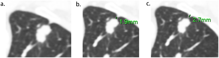 Using the length of pleural tag to predetermine pleural invasion by lung adenocarcinomas.