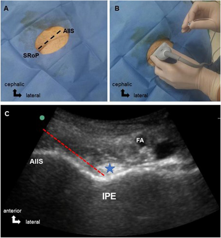 The effect of pericapsular nerve group (PENG) block on postoperative analgesia in elderly patients who underwent proximal femoral nail anti-rotation surgery: a prospective, randomized-controlled trial.