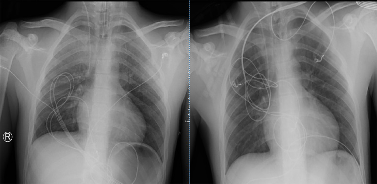 Neurogenic Pulmonary Edema in a Patient with Traumatic Brain Injury.
