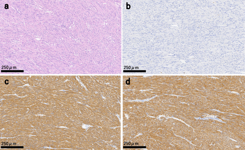 Appendiceal neurofibroma after resection of multiple gastrointestinal stromal tumors of the small intestine in a patient with neurofibromatosis type 1: a case report.