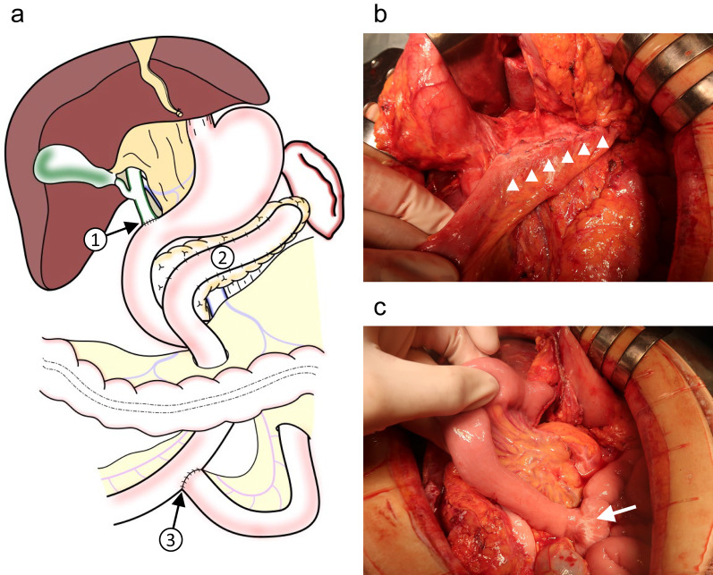 Simplified technique in total pancreatectomy with islet cell autotransplantation after Frey's procedure: a case report.