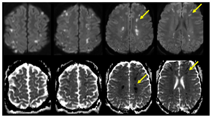 Acute Border Zone Infarcts in Hypereosinophilic Syndrome.