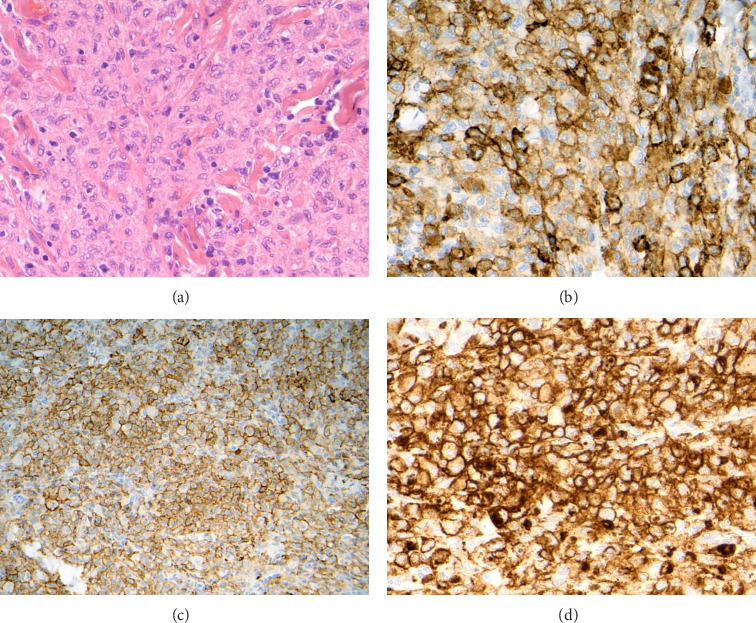 Widespread Cutaneous Indeterminate Dendritic Cell Tumor (IDCT) With ETV3::NOAC2 Rearrangement Successfully Treated With PUVA Therapy: A Case Report.
