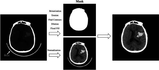 Dual-task vision transformer for rapid and accurate intracerebral hemorrhage CT image classification.