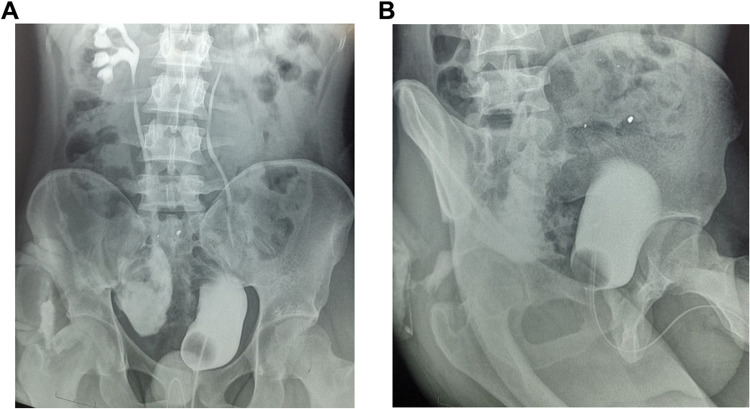 Appendicular Ureteroplasty for a Firearm Related Rupture of the Right Ureter.