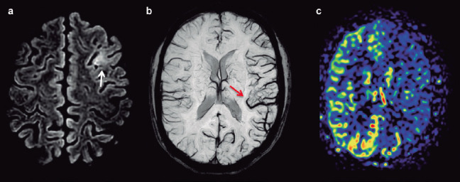 [Hemiplegic migraine: classic findings in a rare pathology].