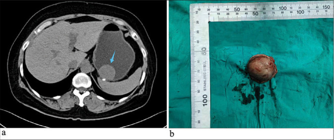 Gastrointestinal stromal tumor mimicking perineurioma: A case report.