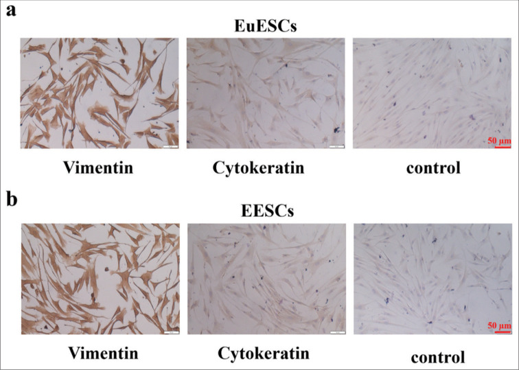 Inhibition of lysine-specific histone demethylase 1A suppresses adenomyosis through reduction in ectopic endometrial stromal cell proliferation, migration, and invasion.