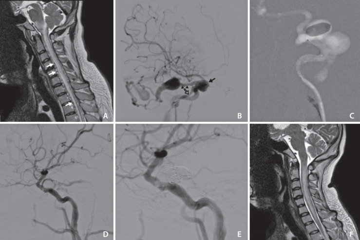 Delayed Pontomesencephalic and Cervical Cord Venous Drainage Followed by Contralateral Carotid-Cavernous Fistula after Craniofacial Fractures: A Case Report.