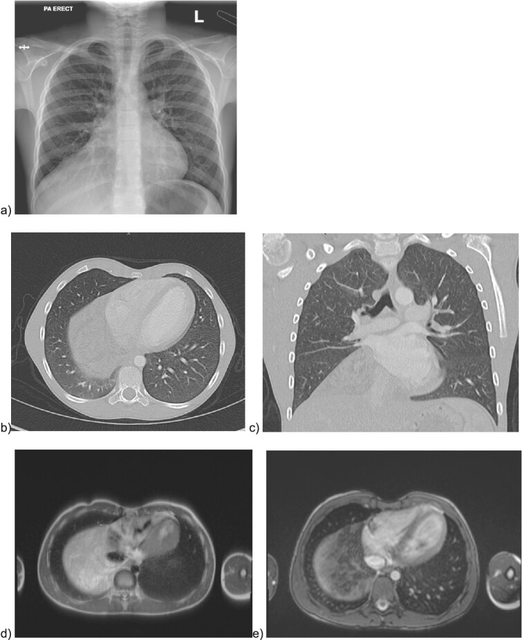 Robotic resection of a giant thymolipoma in a pediatric patient.