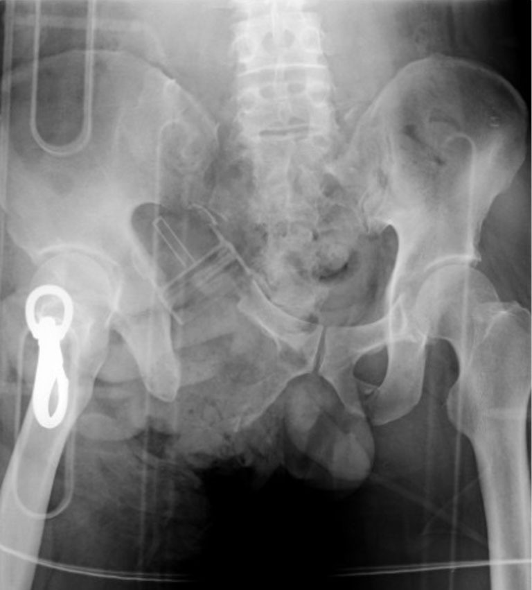 Polymicrobial infection presenting as non-clostridial gas gangrene in a patient with an open pelvic ring fracture accompanied by abdominal evisceration: a case report.