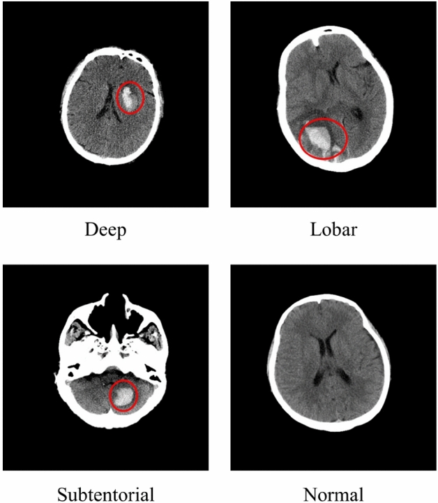 Dual-task vision transformer for rapid and accurate intracerebral hemorrhage CT image classification.