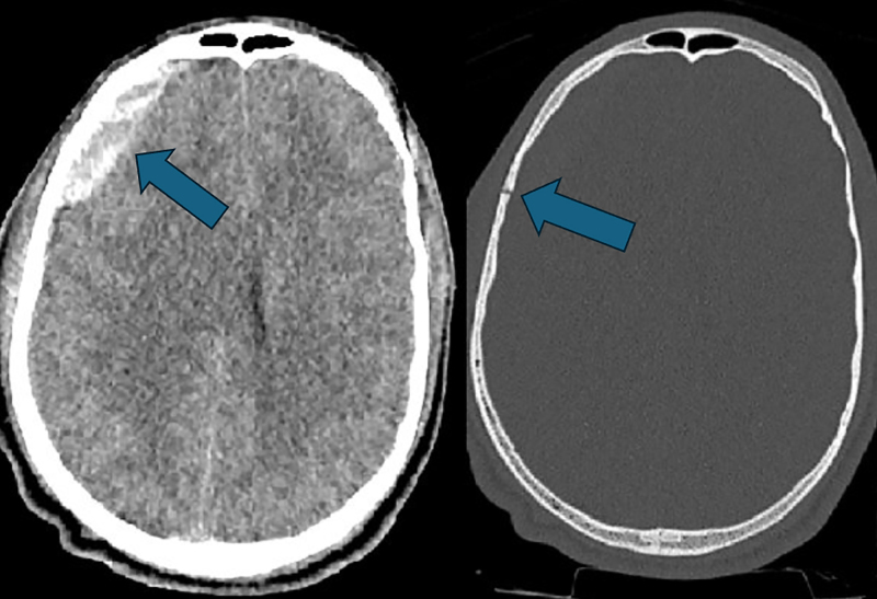 Neurogenic Pulmonary Edema in a Patient with Traumatic Brain Injury.