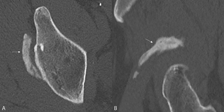 Heterotopic Ossification of the Indirect Head of the Rectus Femoris.