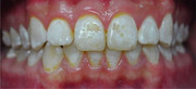 Community Water Fluoridation a Cost-Benefit-Risk Consideration.