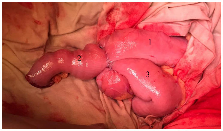 Retroperitoneal pancreas transplantation with a Roux-en-Y duodenojejunostomy for exocrine drainage.