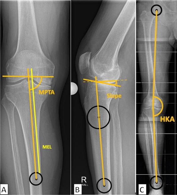 Fractures in Oxford unicompartmental knee arthroplasty are associated with a decreased medial keel-cortex distance of the tibial implant.
