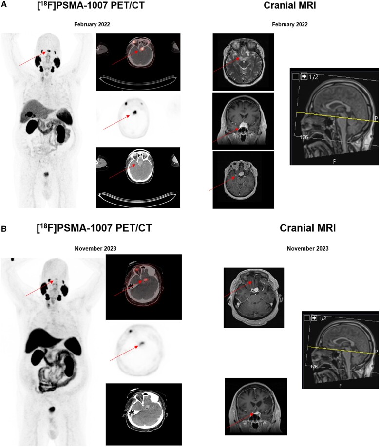A challenging discrimination of an intensely [<sup>18</sup>F]PSMA-1007-avid solitary lesion at the skull base in a patient with biochemical recurrence of prostate cancer.