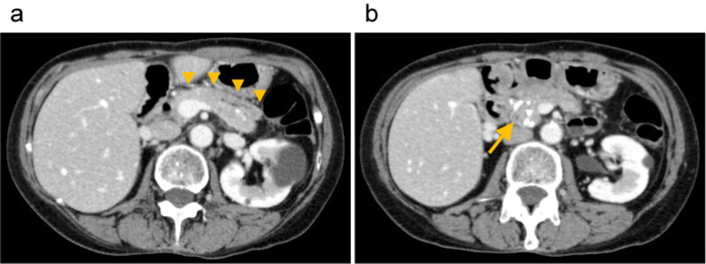 Simplified technique in total pancreatectomy with islet cell autotransplantation after Frey's procedure: a case report.