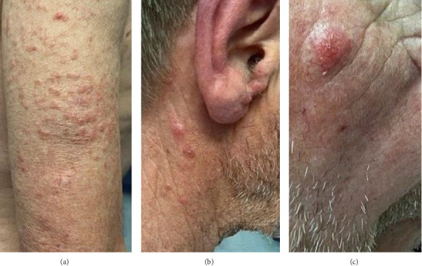 Widespread Cutaneous Indeterminate Dendritic Cell Tumor (IDCT) With ETV3::NOAC2 Rearrangement Successfully Treated With PUVA Therapy: A Case Report.