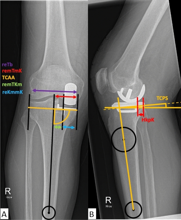 Fractures in Oxford unicompartmental knee arthroplasty are associated with a decreased medial keel-cortex distance of the tibial implant.