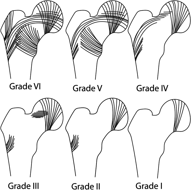 The cemented stem in hip arthroplasty - state of the art technique and recommendations.