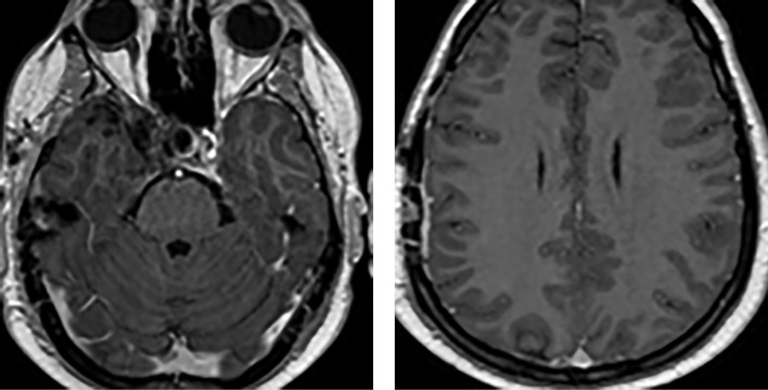 [Efficacy of standard methods in the treatment of prolactin-secreting pituitary carcinoma].