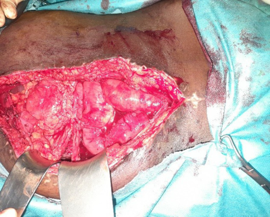 Appendicular Ureteroplasty for a Firearm Related Rupture of the Right Ureter.