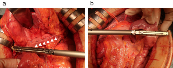 Simplified technique in total pancreatectomy with islet cell autotransplantation after Frey's procedure: a case report.