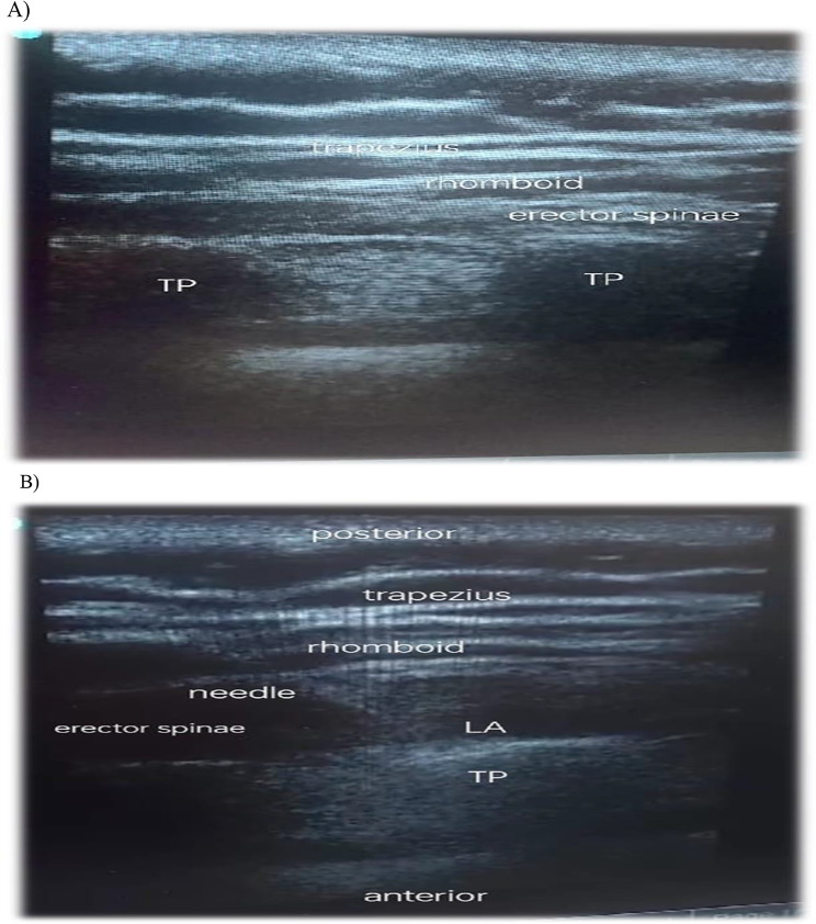 Comparison between ultrasound guided erector spinae plane block and paravertebral block on acute and chronic post mastectomy pain after modified radical mastectomy: randomized controlled trial.