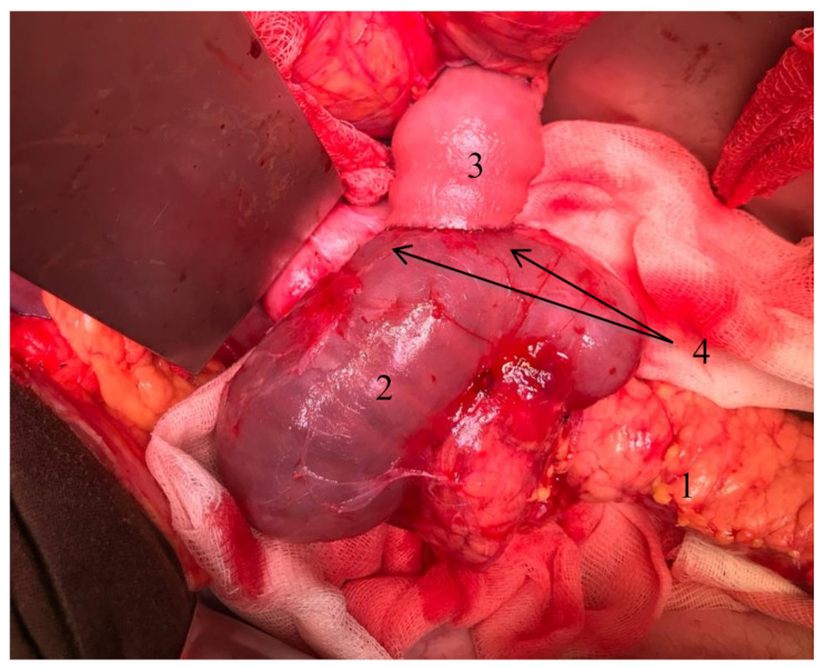 Retroperitoneal pancreas transplantation with a Roux-en-Y duodenojejunostomy for exocrine drainage.